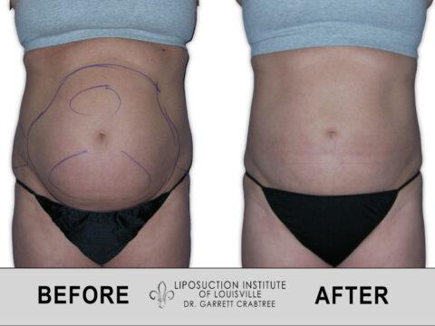 Liposuction Institute of Louisville – Female Abdomen Before After 001