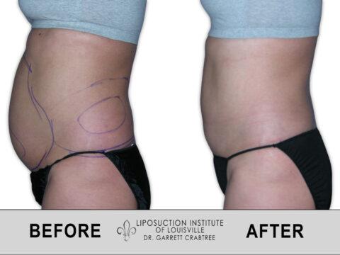Liposuction Institute of Louisville – Female Abdomen Before After 002