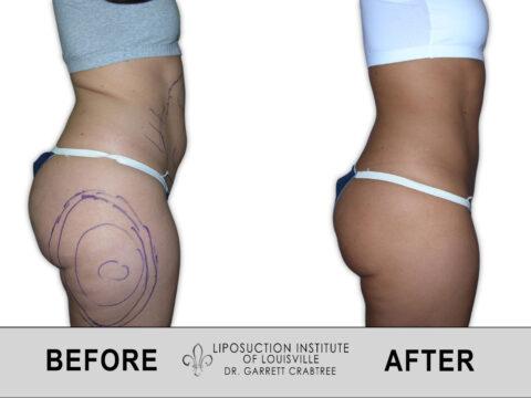 Liposuction Institute of Louisville – Female Abdomen Before After 003