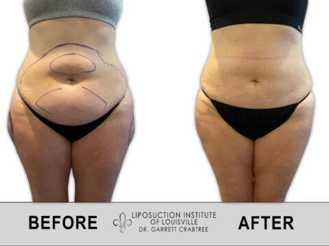 Liposuction Institute of Louisville – Female Abdomen Before After 004