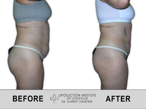 Liposuction Institute of Louisville – Female Abdomen Before After 006