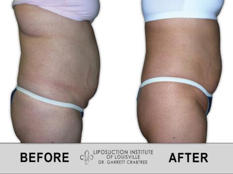 Liposuction Institute of Louisville – Female Abdomen Before After 007