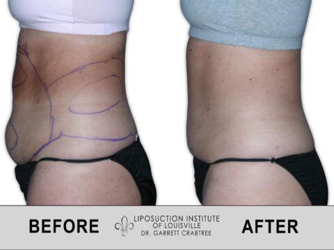 Liposuction Institute of Louisville – Female Abdomen Before After 008