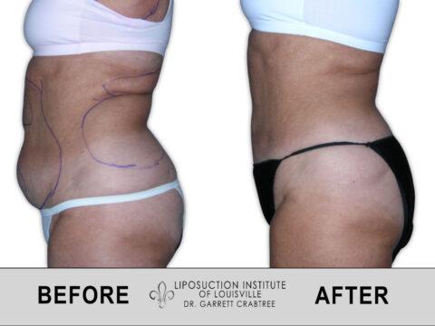 Liposuction Institute of Louisville – Female Abdomen Before After 009