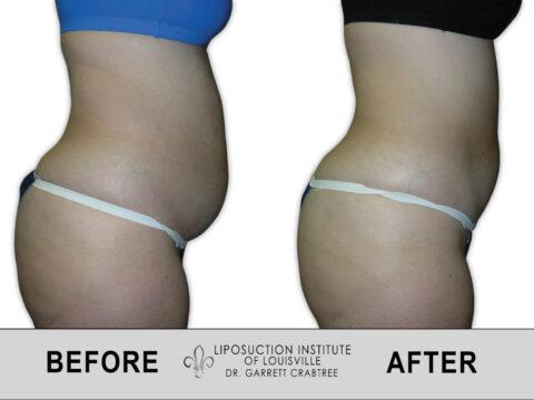 Liposuction Institute of Louisville – Female Abdomen Before After 010
