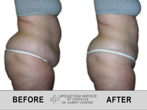 Liposuction Institute of Louisville – Female Abdomen Before After 011