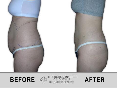 Liposuction Institute of Louisville – Female Abdomen Before After 012