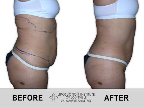 Liposuction Institute of Louisville – Female Abdomen Before After 013