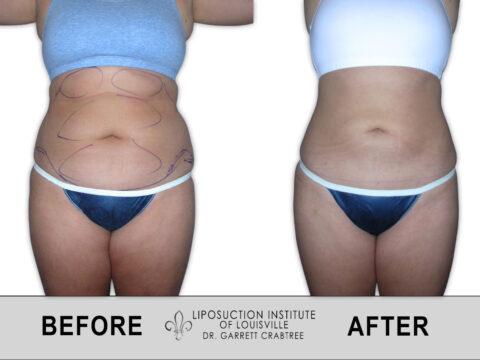 Liposuction Institute of Louisville – Female Abdomen Before After 014
