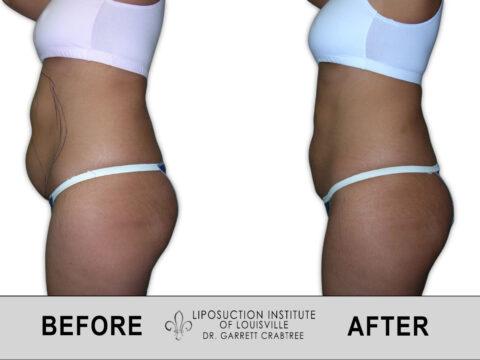 Liposuction Institute of Louisville – Female Abdomen Before After 015