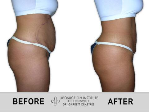 Liposuction Institute of Louisville – Female Abdomen Before After 016