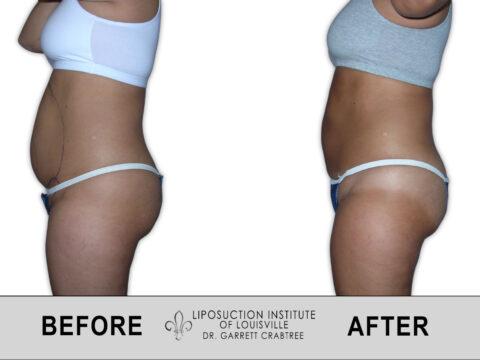 Liposuction Institute of Louisville – Female Abdomen Before After 018