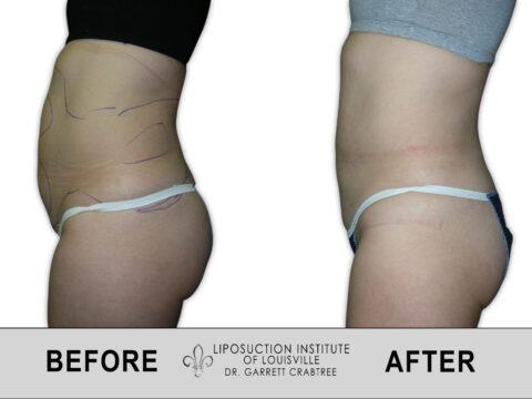 Liposuction Institute of Louisville – Female Abdomen Before After 019