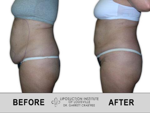 Liposuction Institute of Louisville – Female Abdomen Before After 020
