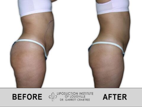 Liposuction Institute of Louisville – Female Abdomen Before After 022