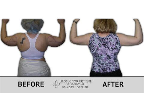 Liposuction Institute of Louisville – Female Arms Before After 001