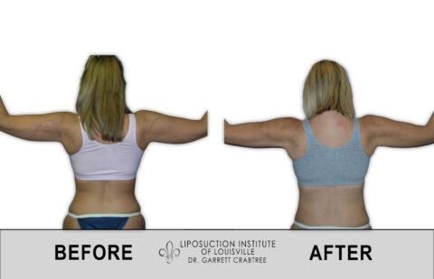 Liposuction Institute of Louisville – Female Arms Before After 002