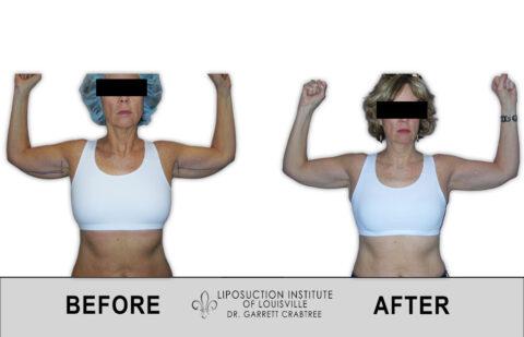Liposuction Institute of Louisville – Female Arms Before After 003