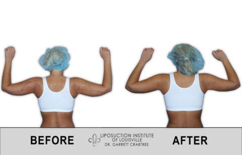 Liposuction Institute of Louisville – Female Arms Before After 004