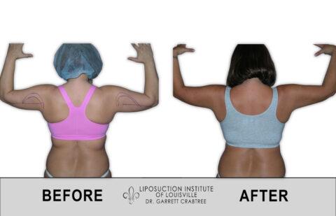 Liposuction Institute of Louisville – Female Arms Before After 005