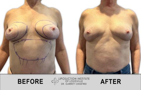 Liposuction Institute of Louisville – Female Breast Reduction Before After 001