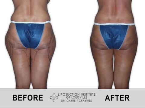 Liposuction Institute of Louisville – Female Inner Thighs Before After 001