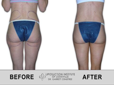 Liposuction Institute of Louisville – Female Love Handles Before After 001