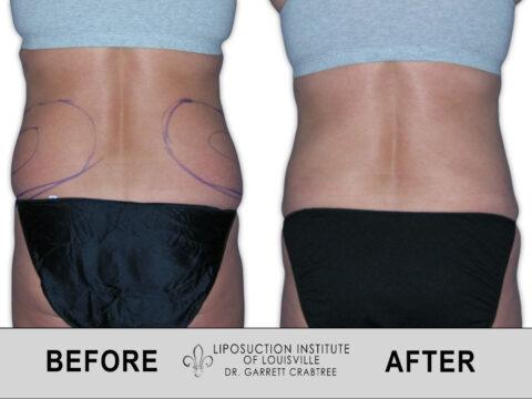 Liposuction Institute of Louisville – Female Love Handles Before After 002