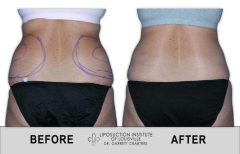 Liposuction Institute of Louisville – Female Love Handles Before After 003