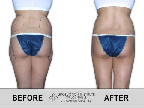 Liposuction Institute of Louisville – Female Love Handles Before After 004