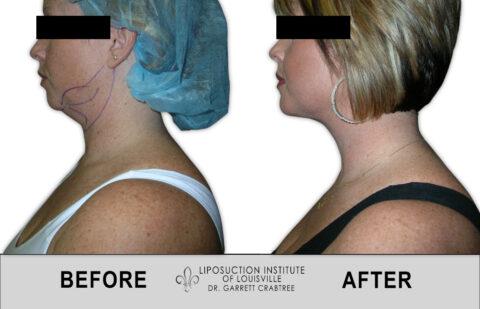 Liposuction Institute of Louisville – Female Neck Before After 001