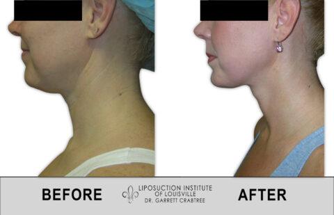 Liposuction Institute of Louisville – Female Neck Before After 002