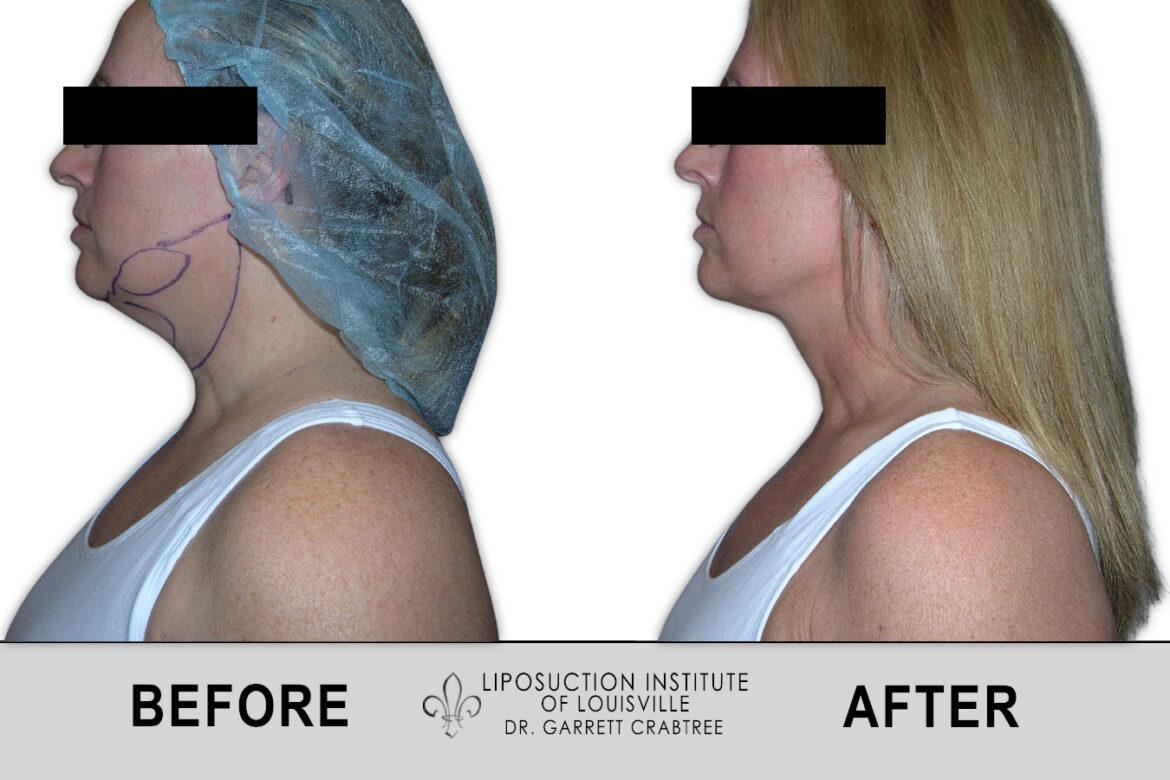 before and after neck liposuction at liposuction institute of louisville