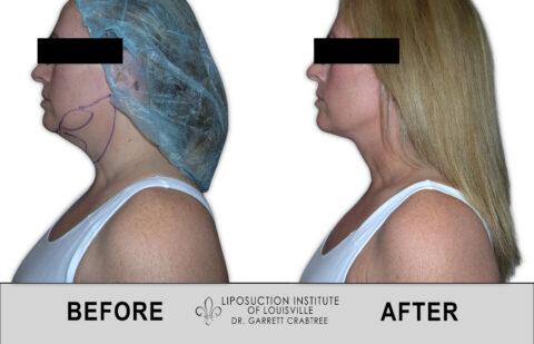 Female Neck Liposuction Before After 003