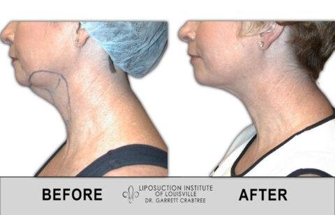 Liposuction Institute of Louisville – Female Neck Before After 004