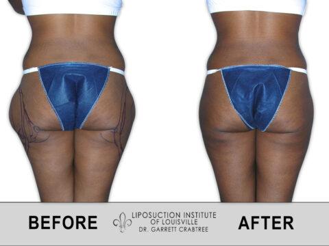 Liposuction Institute of Louisville – Female Outer Thighs Before After 001