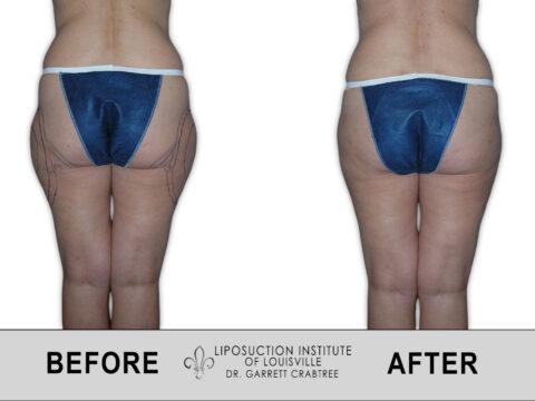 Liposuction Institute of Louisville – Female Outer Thighs Before After 003