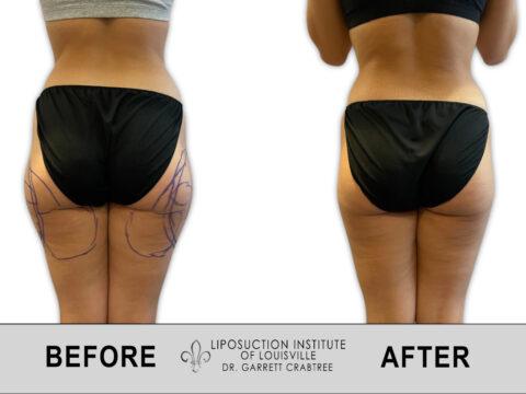 Liposuction Institute of Louisville – Female Outer Thighs Before After 004