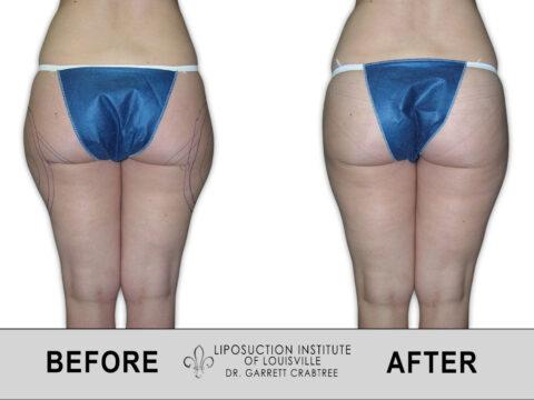 Liposuction Institute of Louisville – Female Outer Thighs Before After 005