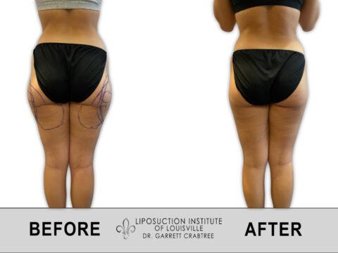 Liposuction Institute of Louisville – Female Outer Thighs Before After 008