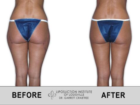 Liposuction Institute of Louisville – Female Outer Thighs Before After 009