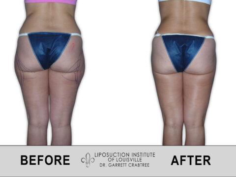 Liposuction Institute of Louisville – Female Outer Thighs Before After 010