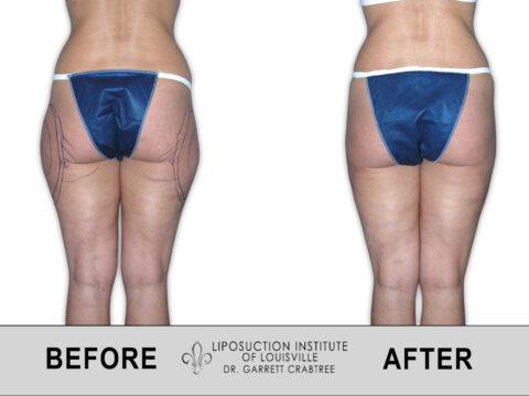 Liposuction Institute of Louisville – Female Outer Thighs Before After 011