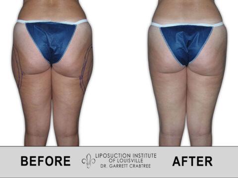 Liposuction Institute of Louisville – Female Outer Thighs Before After 012