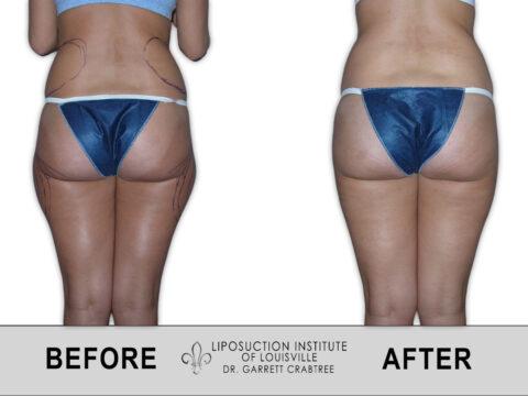 Liposuction Institute of Louisville – Female Outer Thighs Before After 013
