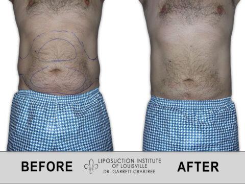 Liposuction Institute of Louisville – Male Abdomen Before After 001