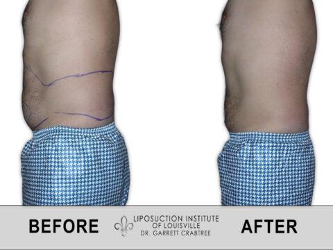 Liposuction Institute of Louisville – Male Abdomen Before After 002