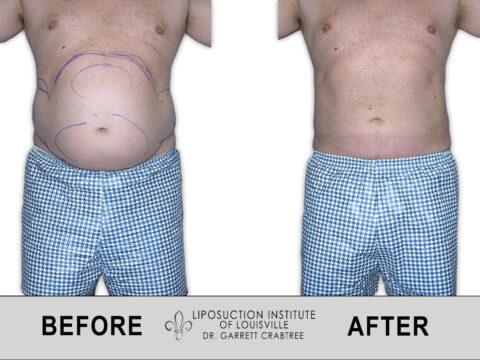 Liposuction Institute of Louisville – Male Abdomen Before After 003
