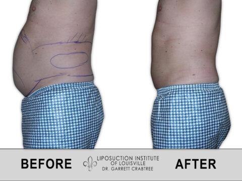 Liposuction Institute of Louisville – Male Abdomen Before After 004