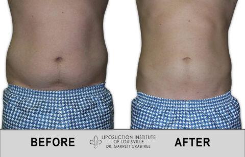 Liposuction Institute of Louisville – Male Abdomen Before After 005